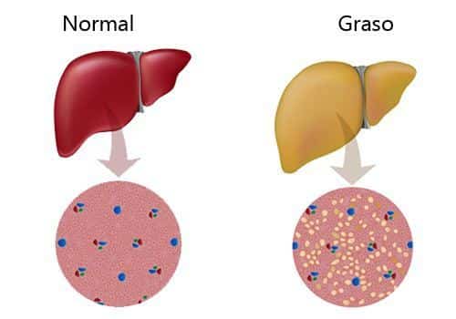 Hígado graso vs normal